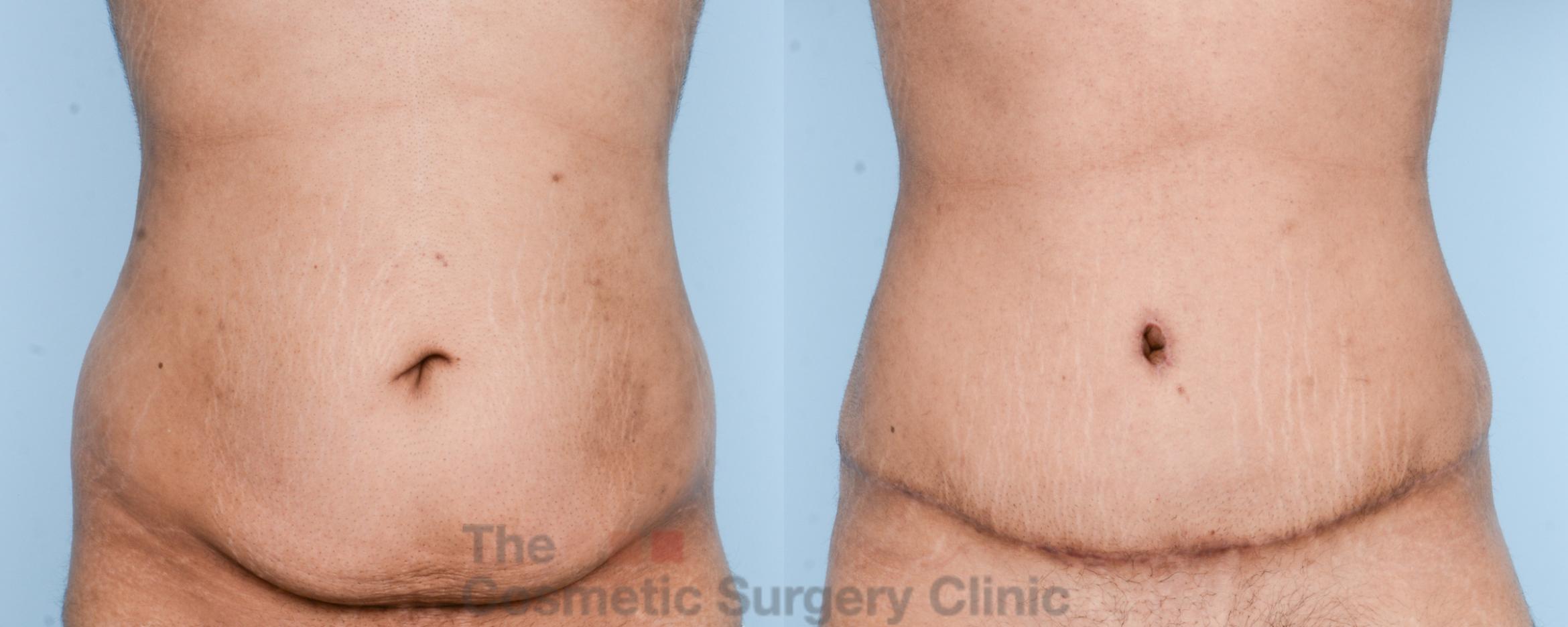 Before & After Tummy Tuck Case 816 Front View in Waterloo, Ontario