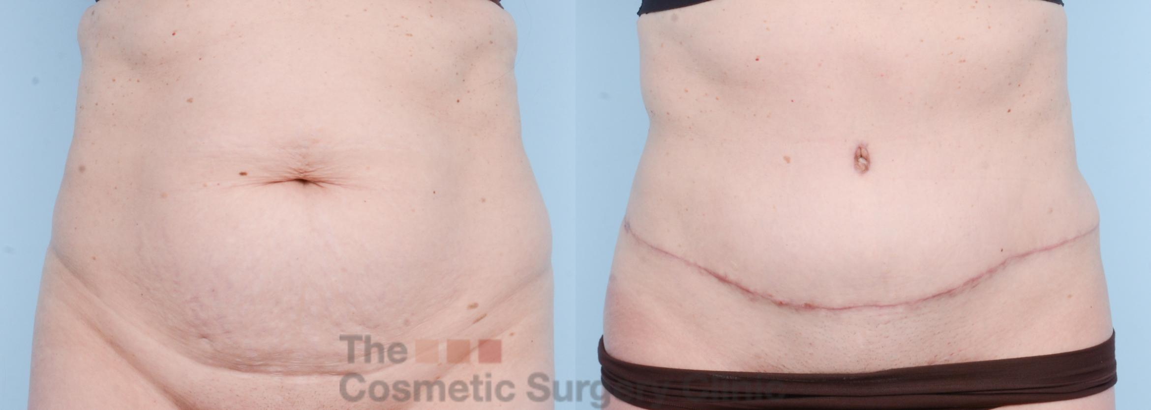 Before & After Tummy Tuck Case 817 Front View in Waterloo, Ontario