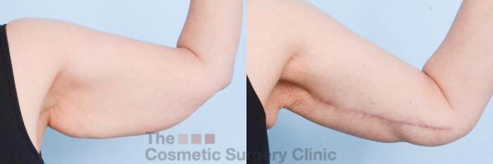 Before & After Arm Lift Case 799 Left Side View in Waterloo, Ontario