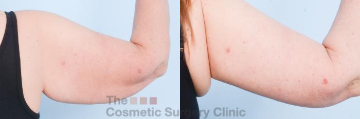 Before & After Arm Lift Case 799 Right Back Side View in Waterloo, Ontario
