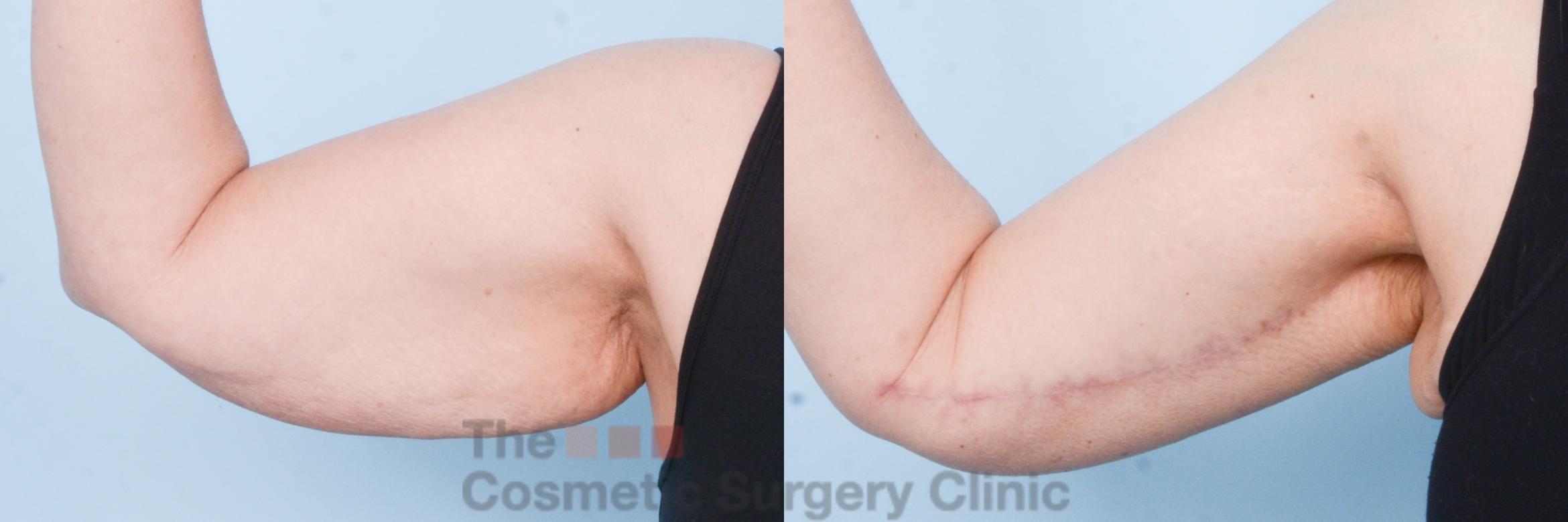 Before & After Arm Lift Case 799 Right Side View in Waterloo, Ontario
