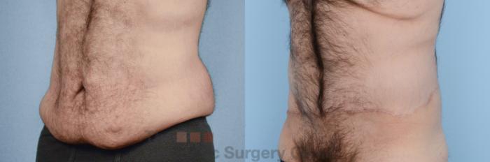 Before & After Body Lift Case 218 View #2 View in Waterloo, Ontario