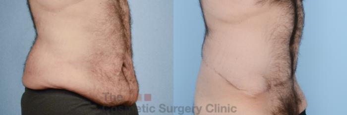 Before & After Body Lift Case 218 View #3 View in Waterloo, Ontario