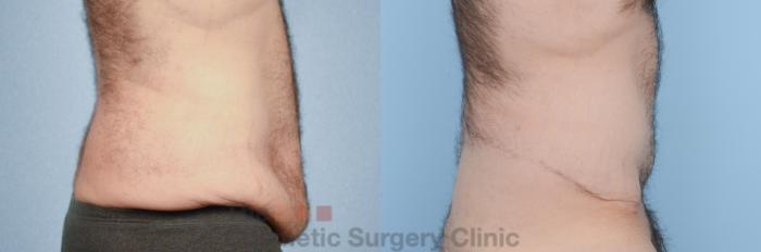 Before & After Body Lift Case 218 View #4 View in Waterloo, Ontario