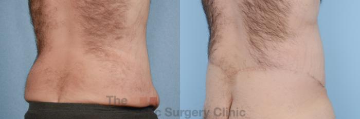 Before & After Body Lift Case 218 View #5 View in Waterloo, Ontario