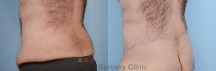 Before & After Body Lift Case 218 View #6 View in Waterloo, Ontario