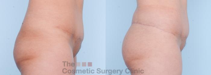 Before & After Body Lift Case 566 View #10 View in Waterloo, Ontario