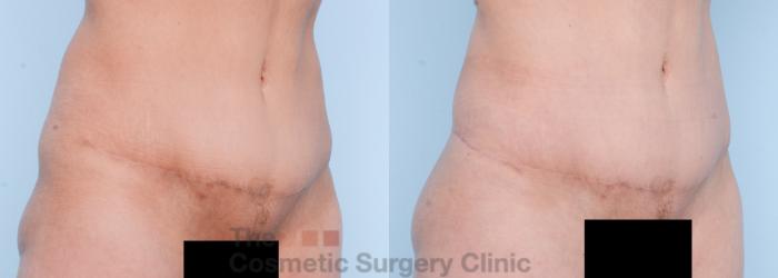 Before & After Body Lift Case 566 View #11 View in Waterloo, Ontario