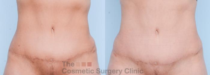 Before & After Body Lift Case 566 View #12 View in Waterloo, Ontario
