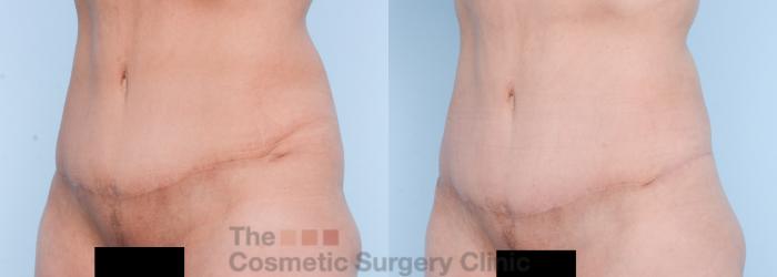 Before & After Body Lift Case 566 View #13 View in Waterloo, Ontario