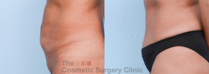 Before & After Body Lift Case 566 View #2 View in Waterloo, Ontario