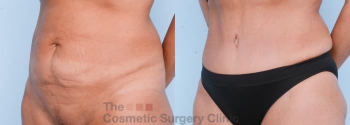 Before & After Body Lift Case 566 View #3 View in Waterloo, Ontario