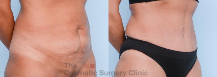 Before & After Body Lift Case 566 View #4 View in Waterloo, Ontario