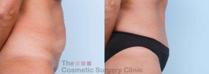 Before & After Body Lift Case 566 View #5 View in Waterloo, Ontario