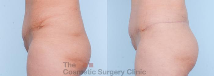 Before & After Body Lift Case 566 View #6 View in Waterloo, Ontario