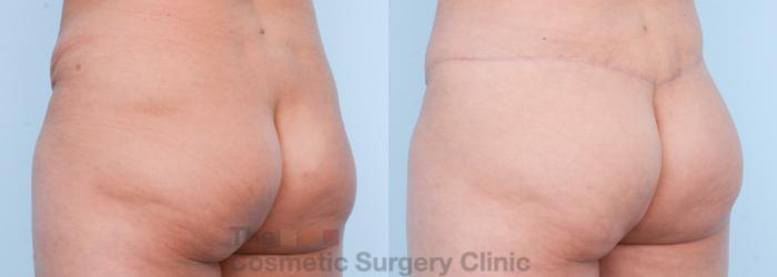 Before & After Body Lift Case 566 View #7 View in Waterloo, Ontario