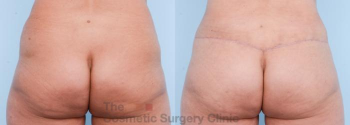 Before & After Body Lift Case 566 View #8 View in Waterloo, Ontario