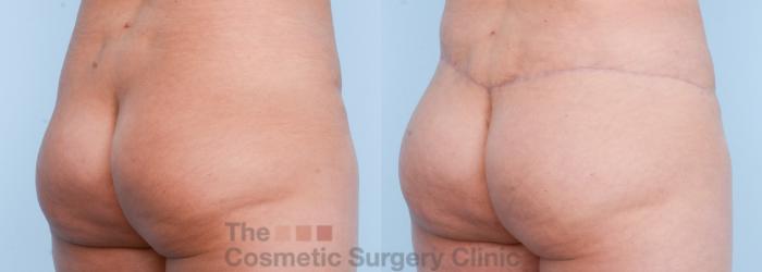 Before & After Body Lift Case 566 View #9 View in Waterloo, Ontario