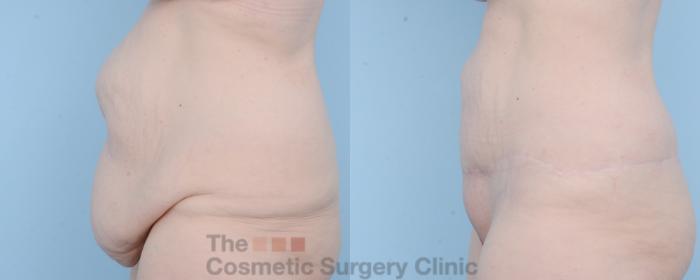 Before & After Body Lift Case 625 View #2 View in Waterloo, Ontario