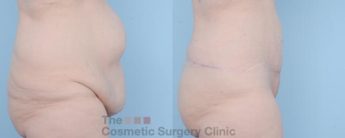 Before & After Body Lift Case 625 View #4 View in Waterloo, Ontario