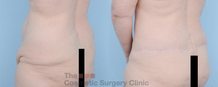 Before & After Body Lift Case 625 View #5 View in Waterloo, Ontario