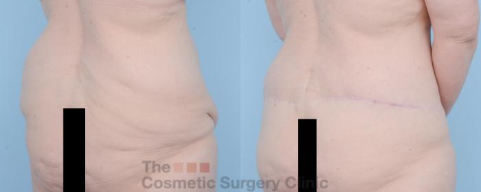 Before & After Body Lift Case 625 View #6 View in Waterloo, Ontario