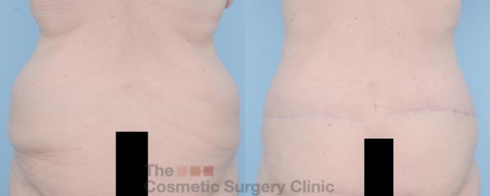Before & After Body Lift Case 625 View #7 View in Waterloo, Ontario