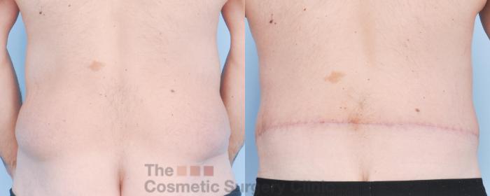 Before & After Body Lift Case 915 Back View in Waterloo, Ontario
