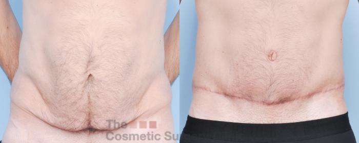 Before & After Body Lift Case 915 Front View in Waterloo, Ontario