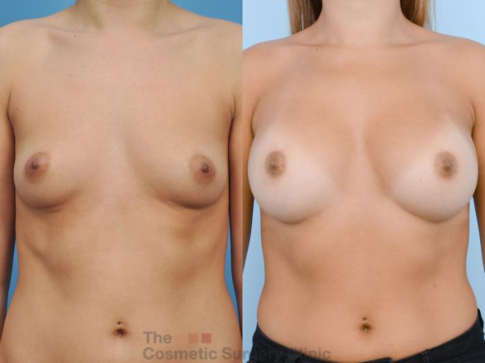 Before & After Breast Augmentation Case 123 View #1 View in Waterloo, Ontario