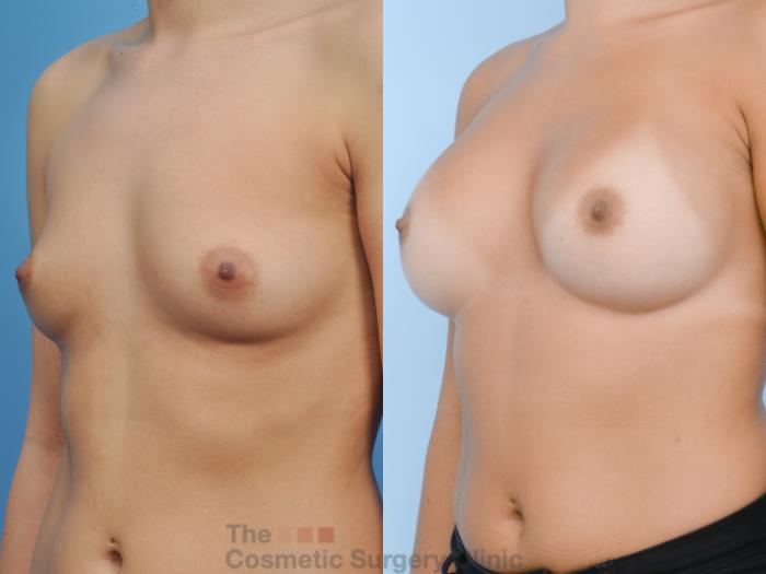 Before & After Breast Augmentation Case 123 View #3 View in Waterloo, Ontario