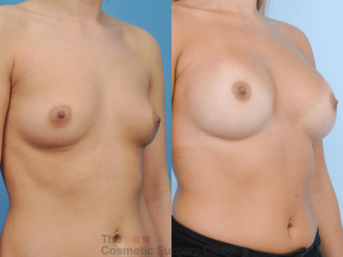 Before & After Breast Augmentation Case 123 View #4 View in Waterloo, Ontario
