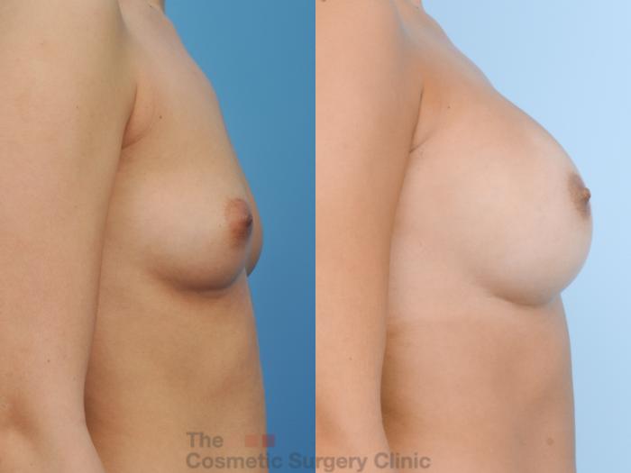Before & After Breast Augmentation Case 123 View #5 View in Waterloo, Ontario