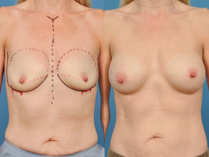 Before & After Breast Augmentation Case 143 View #1 View in Waterloo, Ontario