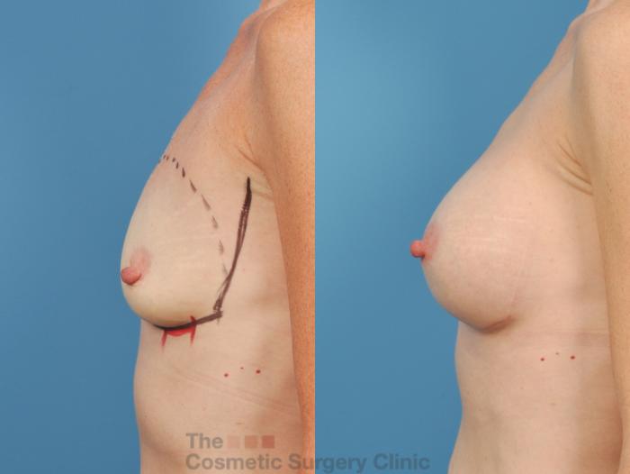 Before & After Breast Augmentation Case 143 View #2 View in Waterloo, Ontario