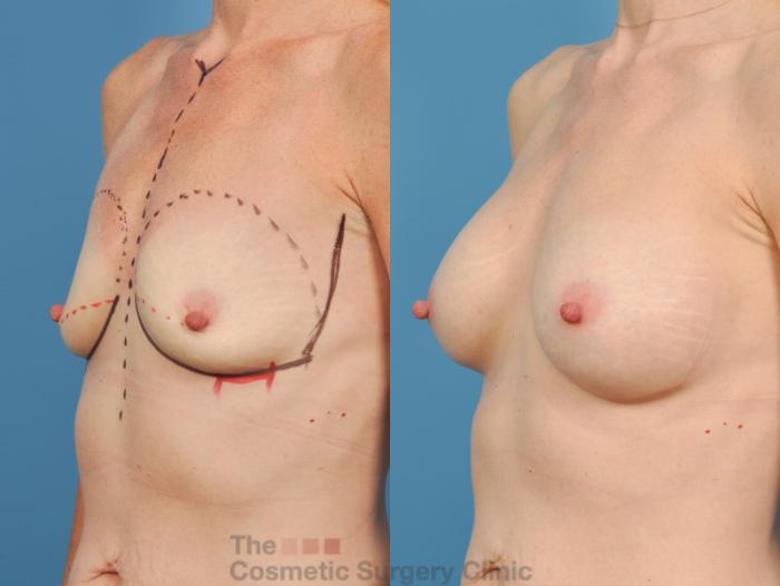 Before & After Breast Augmentation Case 143 View #3 View in Waterloo, Ontario