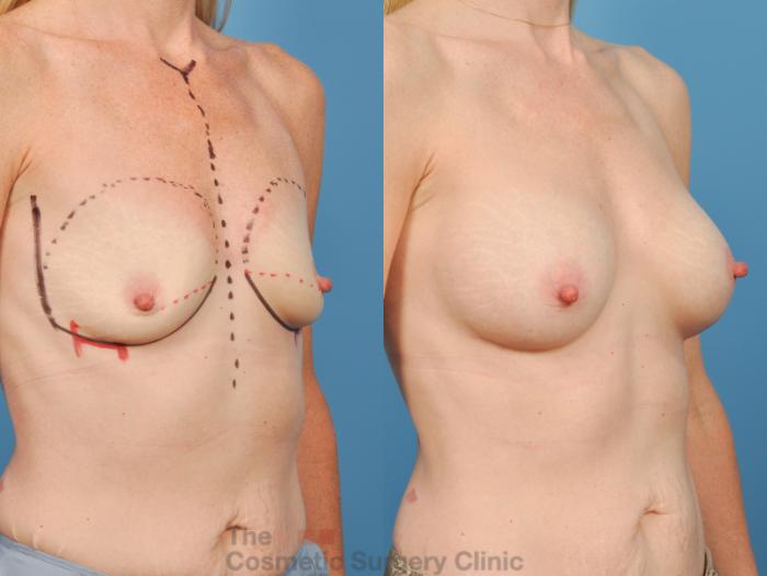 Before & After Breast Augmentation Case 143 View #4 View in Waterloo, Ontario
