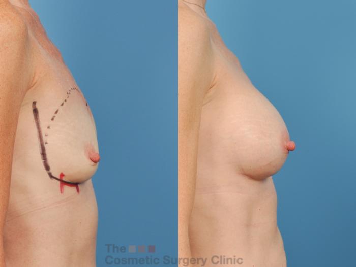 Before & After Breast Augmentation Case 143 View #5 View in Waterloo, Ontario