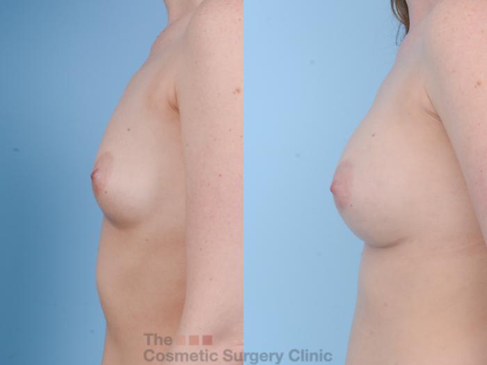 Before & After Breast Augmentation Case 157 View #2 View in Waterloo, Ontario
