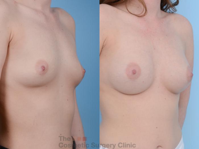 Before & After Breast Augmentation Case 157 View #4 View in Waterloo, Ontario