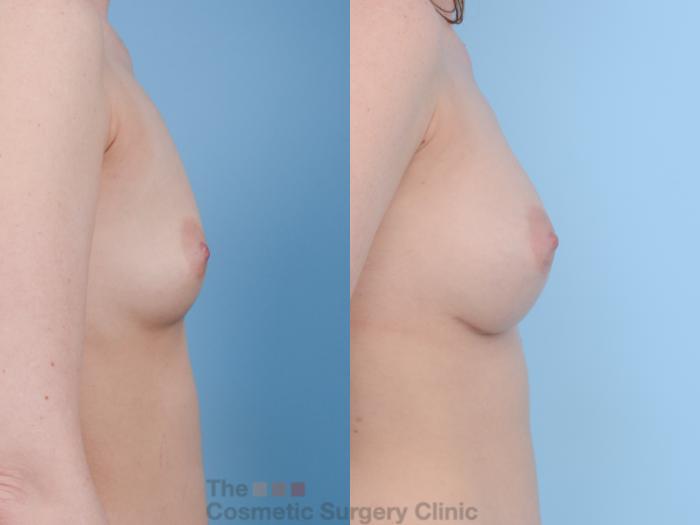 Before & After Breast Augmentation Case 157 View #5 View in Waterloo, Ontario