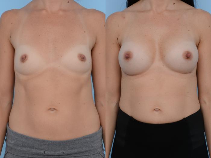 Before & After Breast Augmentation Case 216 View #1 View in Waterloo, Ontario