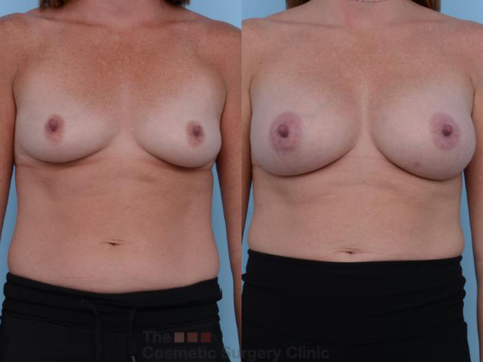 Before & After Breast Augmentation Case 227 View #1 View in Waterloo, Ontario