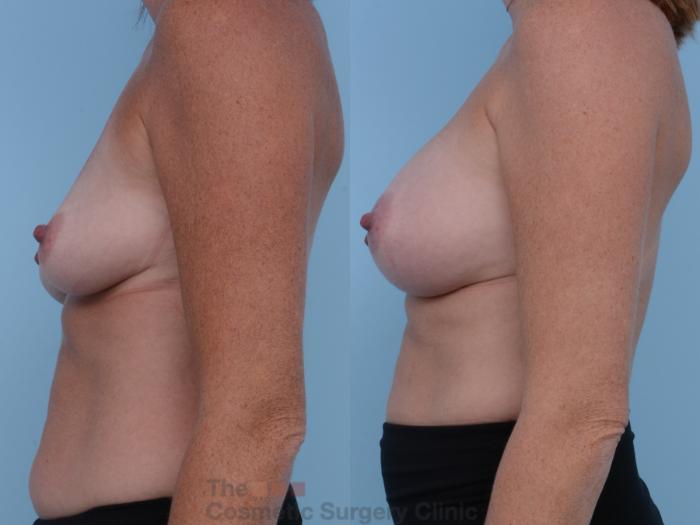 Before & After Breast Augmentation Case 227 View #2 View in Waterloo, Ontario
