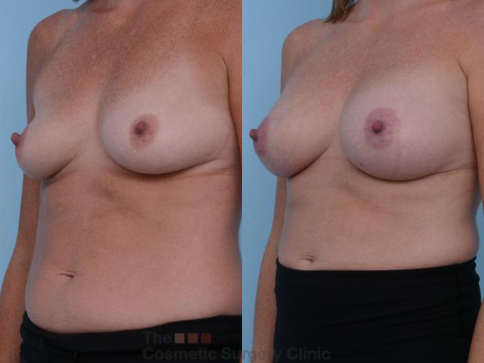 Before & After Breast Augmentation Case 227 View #3 View in Waterloo, Ontario