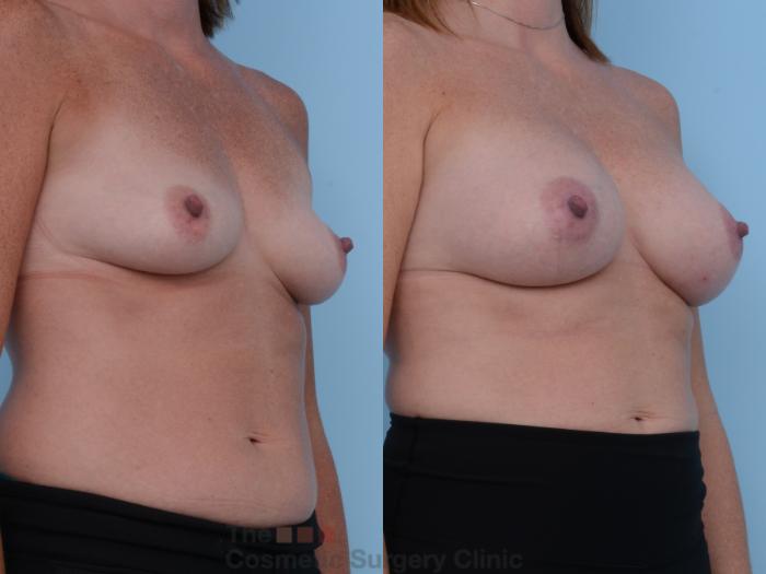 Before & After Breast Augmentation Case 227 View #4 View in Waterloo, Ontario
