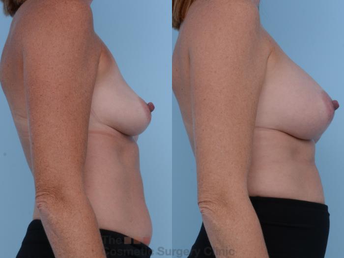 Before & After Breast Augmentation Case 227 View #5 View in Waterloo, Ontario