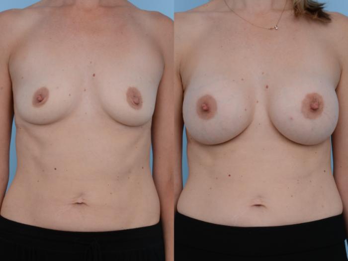 Before & After Breast Augmentation Case 231 View #1 View in Waterloo, Ontario