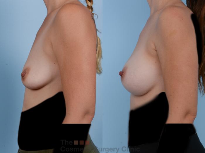 Before & After Breast Augmentation Case 244 View #2 View in Waterloo, Ontario
