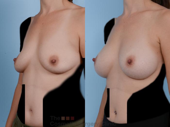 Before & After Breast Augmentation Case 244 View #3 View in Waterloo, Ontario